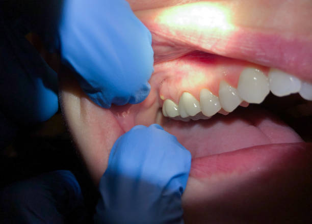 Best Tooth Infection Emergency Dentist  in Prairie Heights, WA