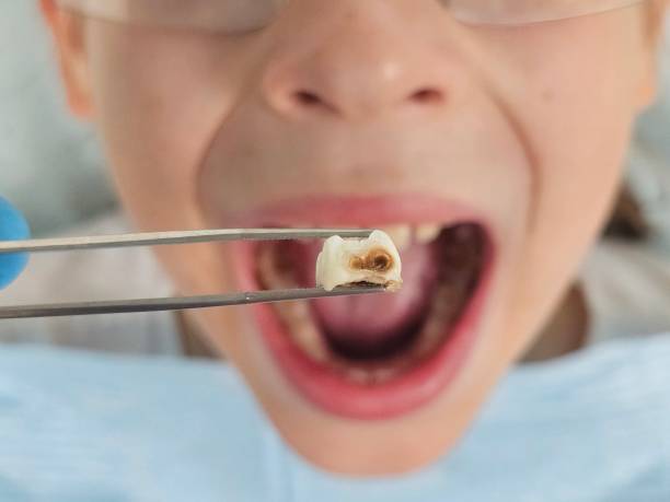 Best Knocked-Out Tooth Emergency  in Prairie Heights, WA